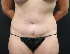 Tummy Tuck