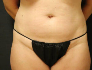 Tummy Tuck