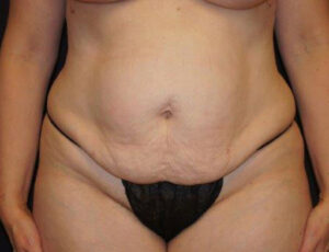 Tummy Tuck