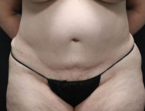 Tummy Tuck