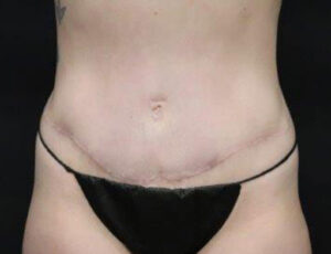 Tummy Tuck