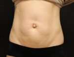 Tummy Tuck