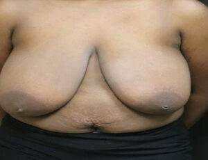 Breast Reduction