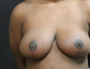 Breast Reduction