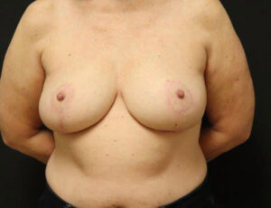 Breast Reduction