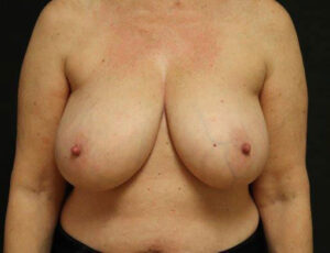 Breast Reduction