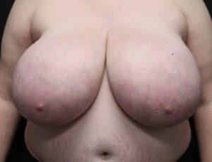 Breast Reduction