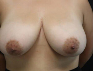 Breast Reduction