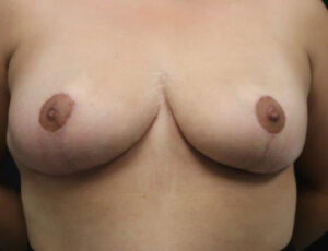 Breast Reduction