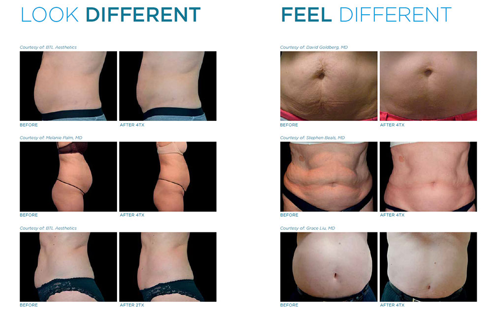 Vanquish Twin Cities  Non-Surgical Body Contouring St. Paul